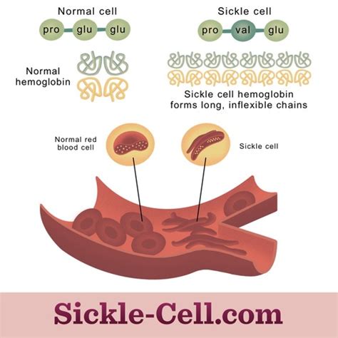 Sickle Cell Anaemia Flashcards Quizlet