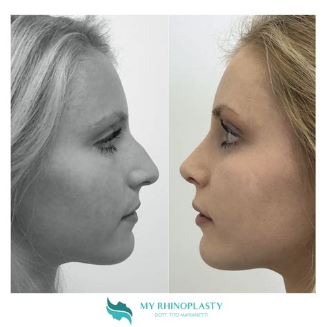 Chirurgia Plastica Naso 4 Cose Che Devi Sapere My Rhinoplasty