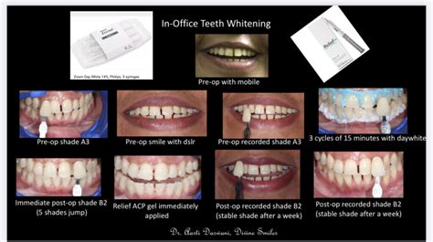 Teeth Whitening