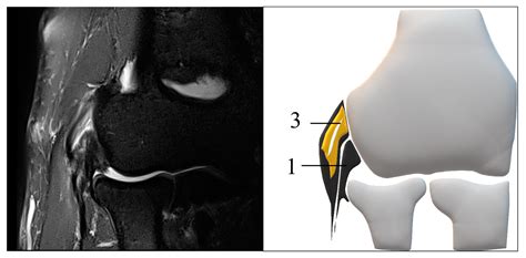 Diagnostics Free Full Text Individual Evaluation Of The Common Extensor Tendon And Lateral