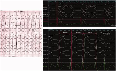 A Twelve Lead Rhythm Strip Of Ventricular Tachycardia VT Showing