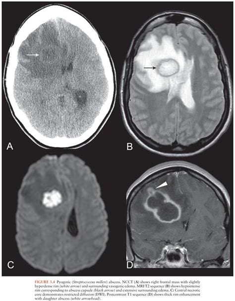 Imaging Of Intracranial Infections Oncohema Key