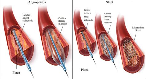 Angioplastia Y Colocaci N De Stent En El Coraz N Grupo I