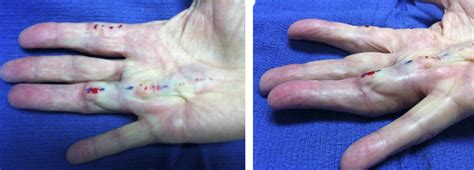 Results Of Needle Aponeurotomy For Dupuytren Contracture In Over 1000 Fingers Journal Of Hand