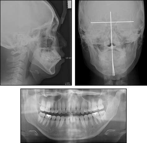 Adult Patient With Hemifacial Microsomia Treated With Combined Orthodontics And Distraction