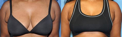 Liposuction Before and After Pictures Plano, Dallas, TX