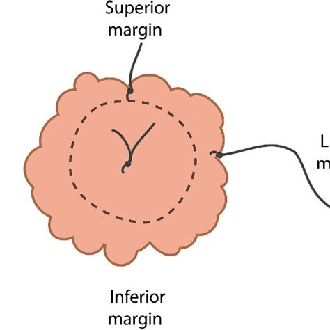 The Mastectomy Specimen Margins Are Marked Superior And Lateral With