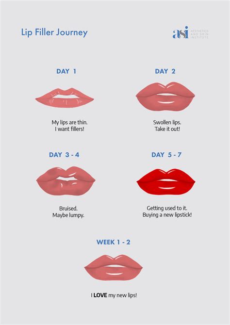 Lip Filler Journey Poster Aesthetics And Skin Institute