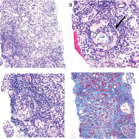 Light Microscopic Features Of Granulomatous Interstitial Nephritis Download Scientific Diagram