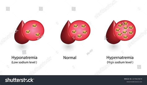 Hypernatremia High Plasma Sodium Level Hyponatremia Stock Vector