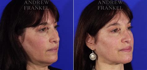 Pdo Thread Lifts A Non Surgical Method For Neck Rejuvenation