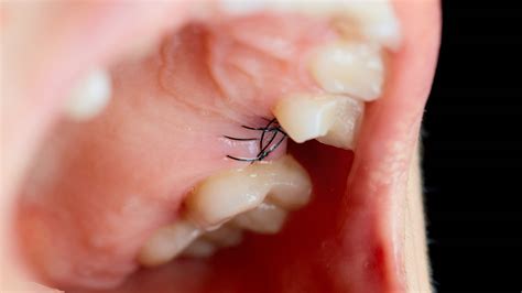 Normal Healing After Tooth Extraction