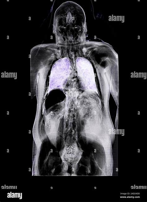 Trapped Abdominal Gas Computed Tomography Ct Scan Air Pockets In