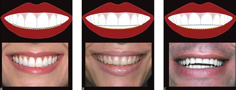 Scielo Brasil 10 Commandments Of Smile Esthetics 10 Commandments Of