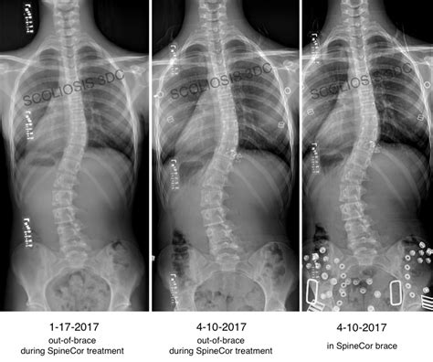 Risser 3 | What is Risser 3 | Risser 3 Scoliosis Treatment