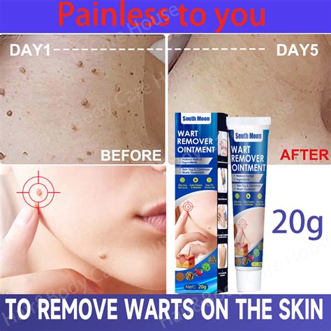 Painless To YouSouth Moon Warts Remover Original Cream 20g Warts