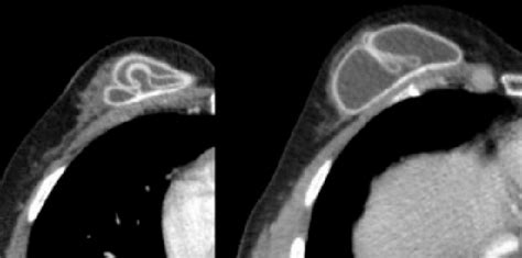 Intracapsular Rupture Of A Breast Implant In A 55 Year Old Women