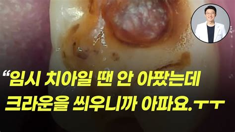 임시 치아일 땐 괜찮았는데 크라운을 씌우고 나니까 통증이 생겼어요 치료 잘못된 거 아닌가요크라운통증 치아통증 Youtube