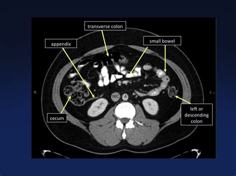 Cross Sectional Anatomy Of The Body MDCT Atlas CTisus CT Scanning