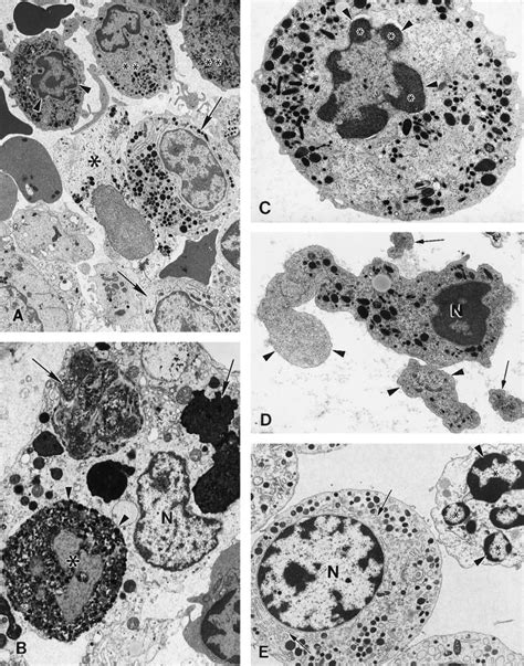 Electron Micrographs Of Bone Marrow From Patient Before Granulocyte