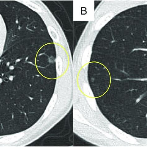 Chest Computed Tomography Findings Chest Computed Tomography Revealed Download Scientific