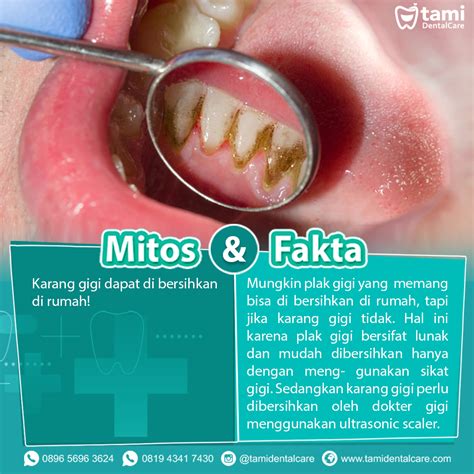 Karang Gigi Tami Dental Care Klinik Dokter Gigi Bandung Bojongsoang