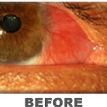 Pterygium after excision. | Download Scientific Diagram