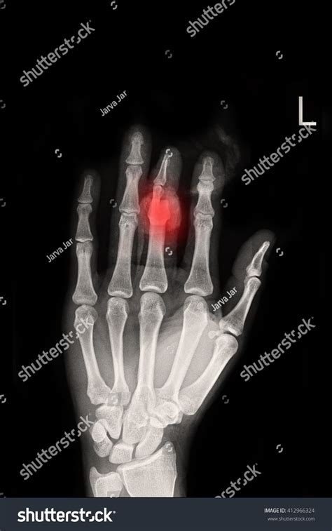 Fracture Middle Finger Left Hand Stock Photo 412966324 | Shutterstock