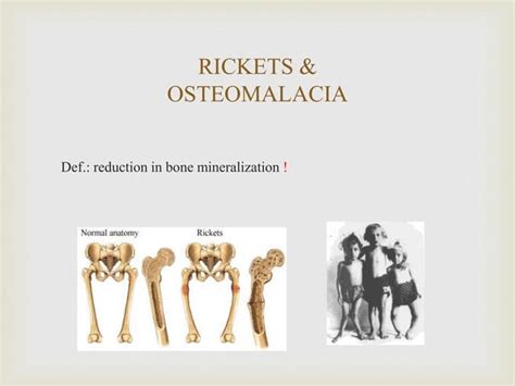 Rickets And Osteomalacia Ppt