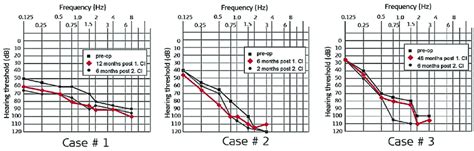 Pure Tone Audiometric Thresholds Determined Preoperatively And