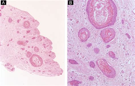Nail Histopathology Actas Dermo Sifiliográficas