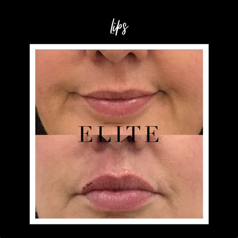 Fillers For Lips Before And After Results From A Qualified Doctor