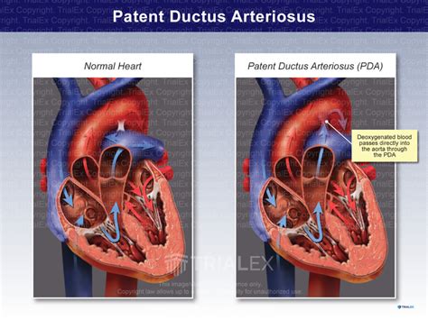 Patent Ductus Arteriosus Pda Trialquest Inc