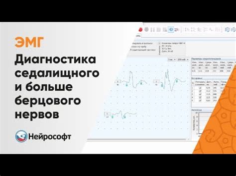 ЭМГ: Диагностика Повреждений Седалищного и Большеберцового Нервов - YouTube