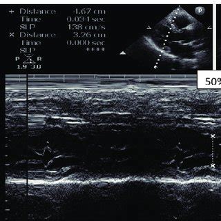 6 ETT Machine Picture In the 7 is patient ETT procedure is given ...