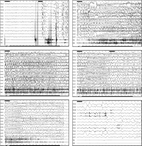 Epilepsy With Myoclonic Astatic Seizures Neupsy Key