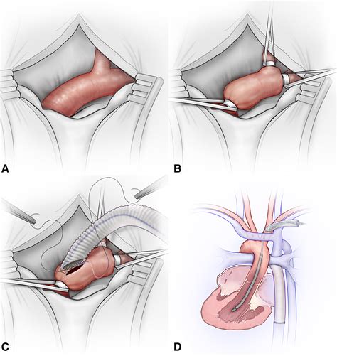 Suprasternal Approach For Implanting A Microaxial Left Ventricular