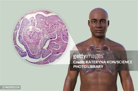 Lung Cancer Illustration High-Res Vector Graphic - Getty Images