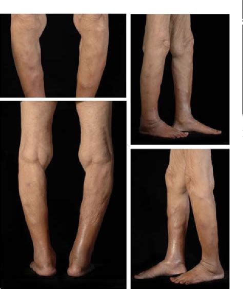 Figure From Pancreatic Panniculitis A Cutaneous Presentation As An