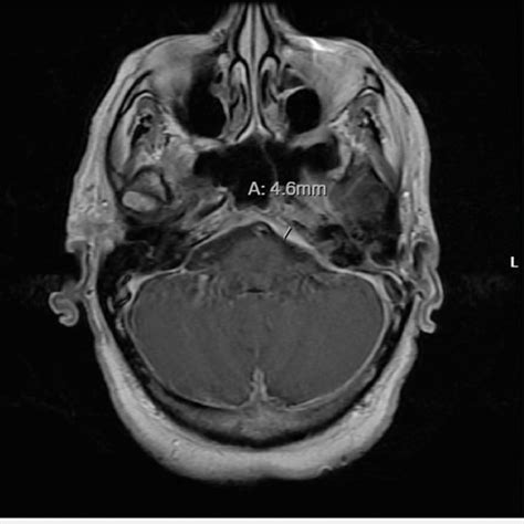 Brain Mri T1 Weighted Axial Section Showing Thickening Of The Left Clivus Download Scientific