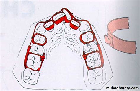 Fixed Orthodontic Appliances Pptx Drhakam Muhadharaty