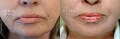 What Is Dermapen Skin Needling The Harley Street Filler Specialist