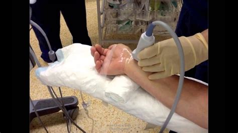 Us Guided Radial Artery Cannulation Youtube