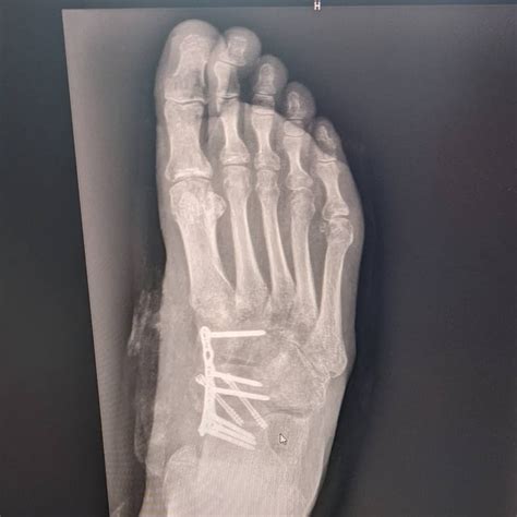 Had A Talonavicular And Navicular Cuneiform Joint Fusion Rpodiatry