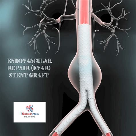 Endovascular Aaa Repair Vascular Info