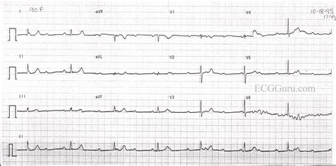 Complete Av Block With Junctional Escape Rhythm Ecg Guru Instructor Resources