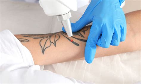 Las dudas más frecuentes sobre la eliminación de tatuajes Nexofin