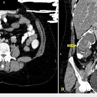 Abdominal Pelvic Ct Scan With Intravenous Oral And Rectal Contrast