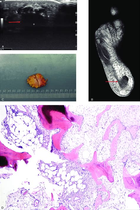 The Images Data Of Tumor Induced Osteomalacia Tio A The Ultrasound Download Scientific