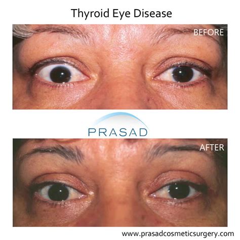 Thyroid Eye Disease Surgery Graves Eye Disease Surgery Dr Prasad